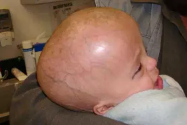 best hospital for hydrocephalus treatment in mohali, best doctor for hydrocephalus treatment  in mohali, cost of hydrocephalus treatment in Punjab, Dr Jaspreet Singh Randhawa, Best Neurosurgeon in Punjab for hydrocephalus, Healing Hospital Chandigarh